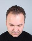 Before Hair Transplant&nbsp;Temporal Hairline
